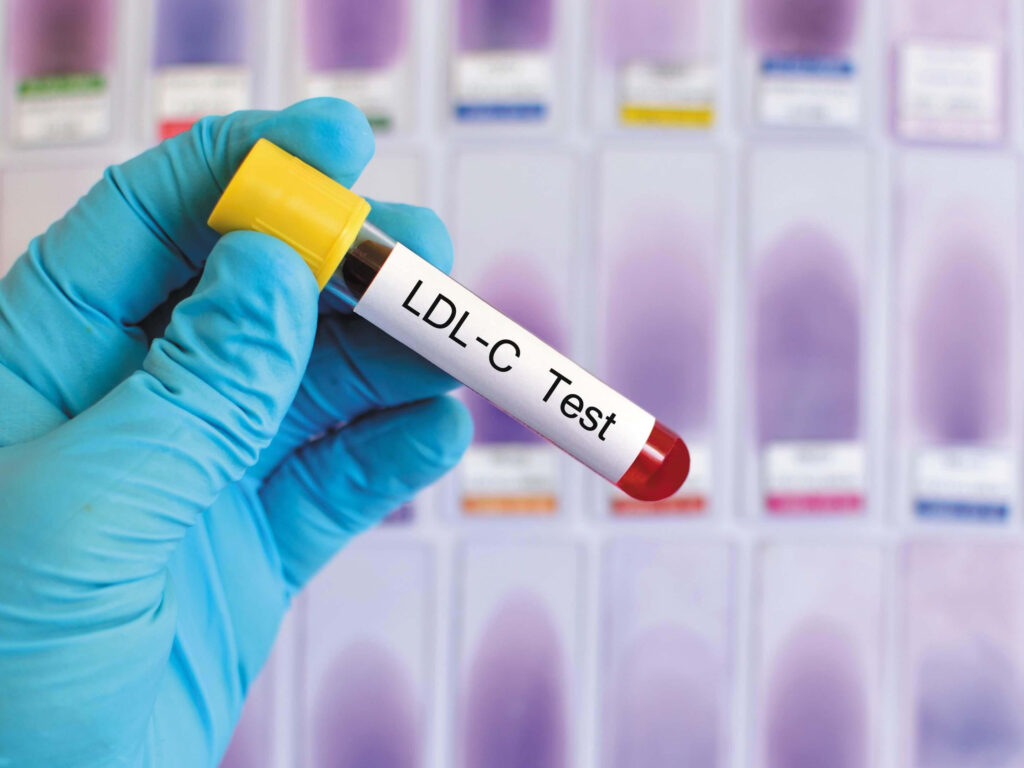 Cholesterol Test Melaka